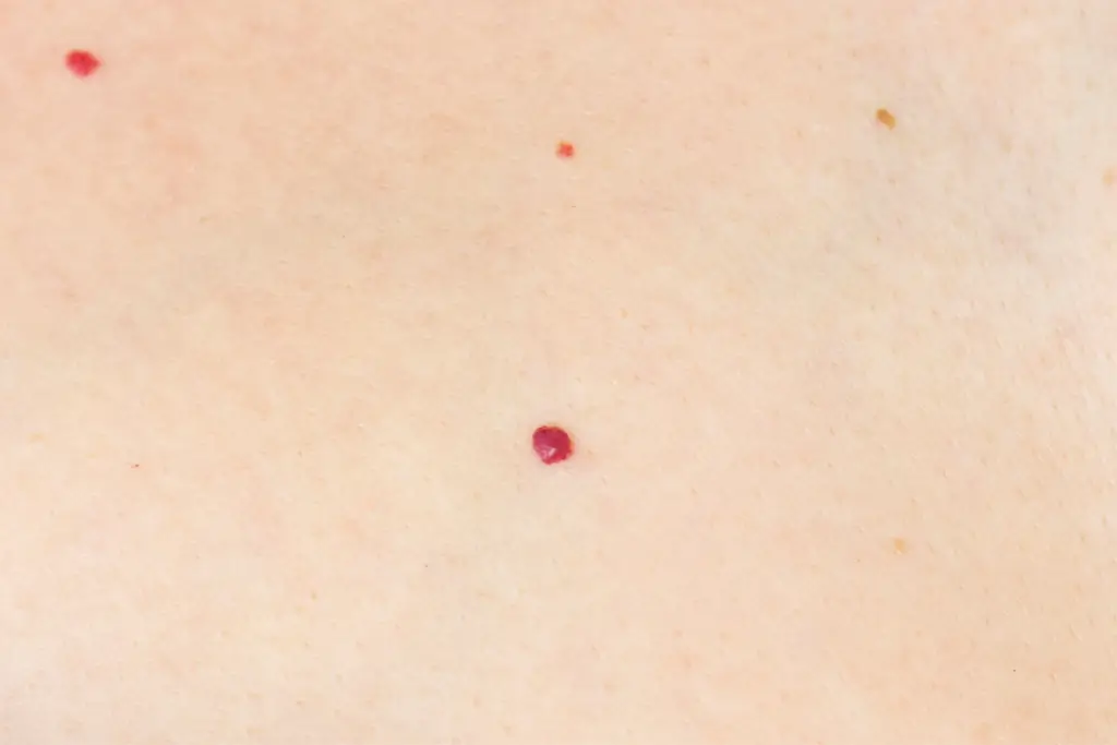 Angiomas in Southlake, TX, at Aero Laser and Skin