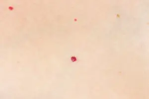 Angiomas in Southlake, TX, at Aero Laser and Skin