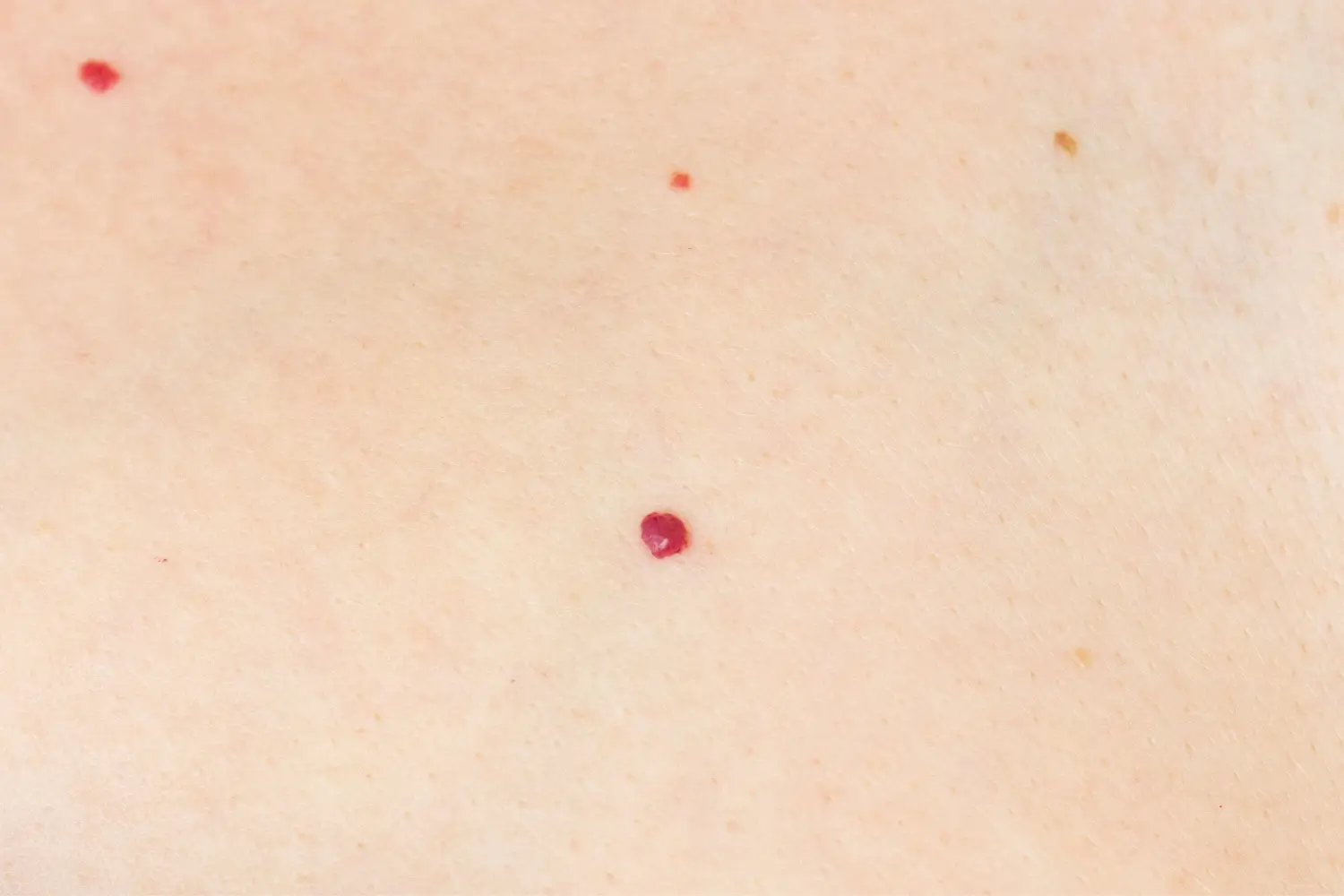 Angiomas in Southlake, TX, at Aero Laser and Skin