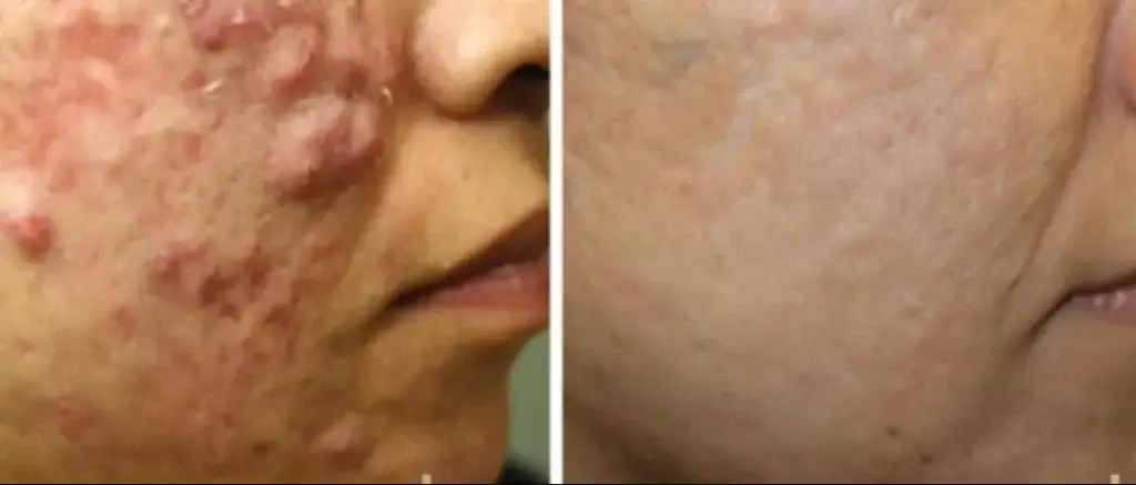 Before and after the procedure at Aerolase Laser in Southlake, Texas