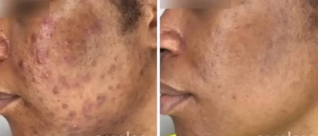 Before and after the procedure at Aerolase Laser in Southlake, Texas