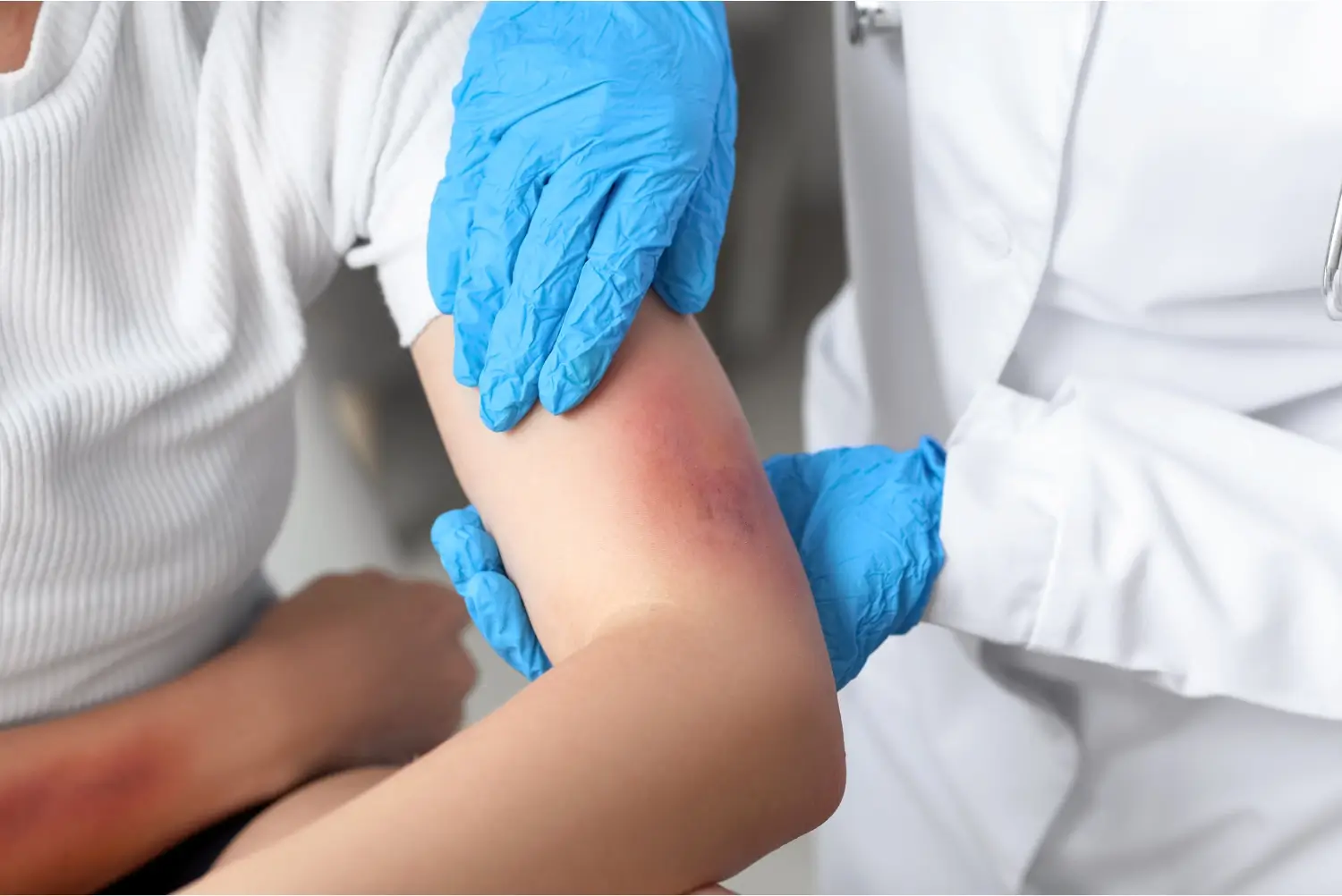 Bruise Treatments in Southlake, TX at Aero Laser and Skin