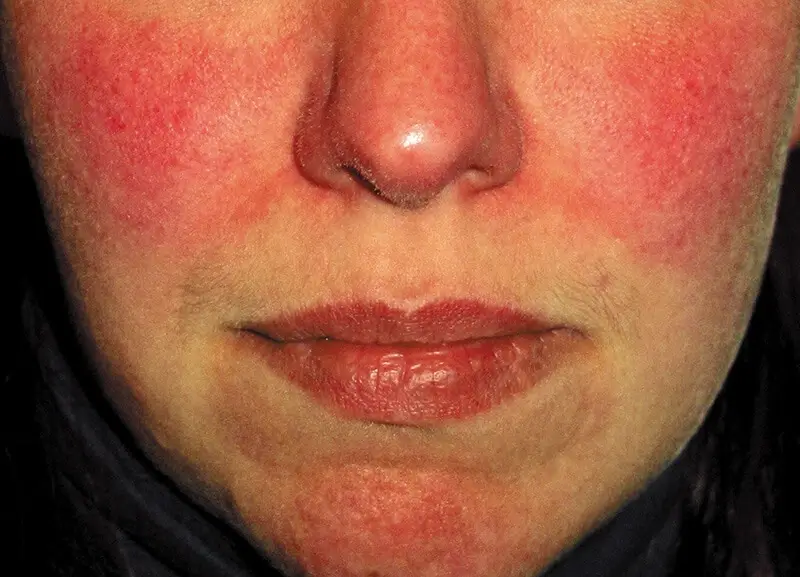 Rosacea and redness treatment in Southlake, TX at Aero Laser and Skin